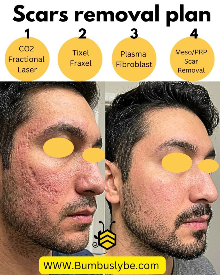 Scare Removal Protocols